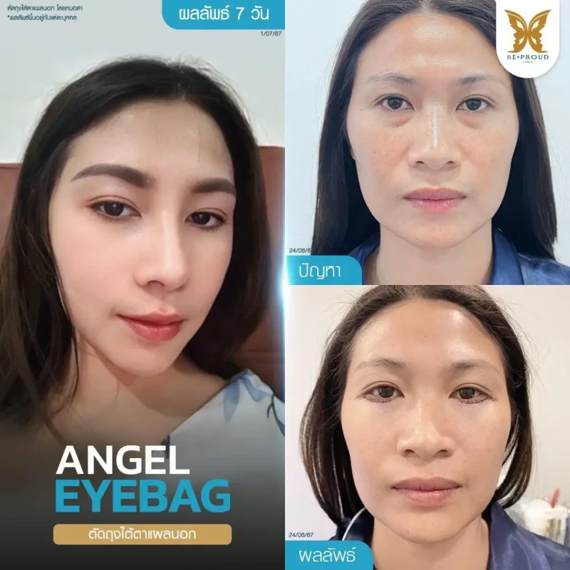 ภาพรีวิวเปรียบเทียบผลลัพธ์ ก่อนทำ-หลังทำศัลยกรรมตัดถุงใต้ตาแผลนอก โดยหมอดา บีพราวด์คลินิก