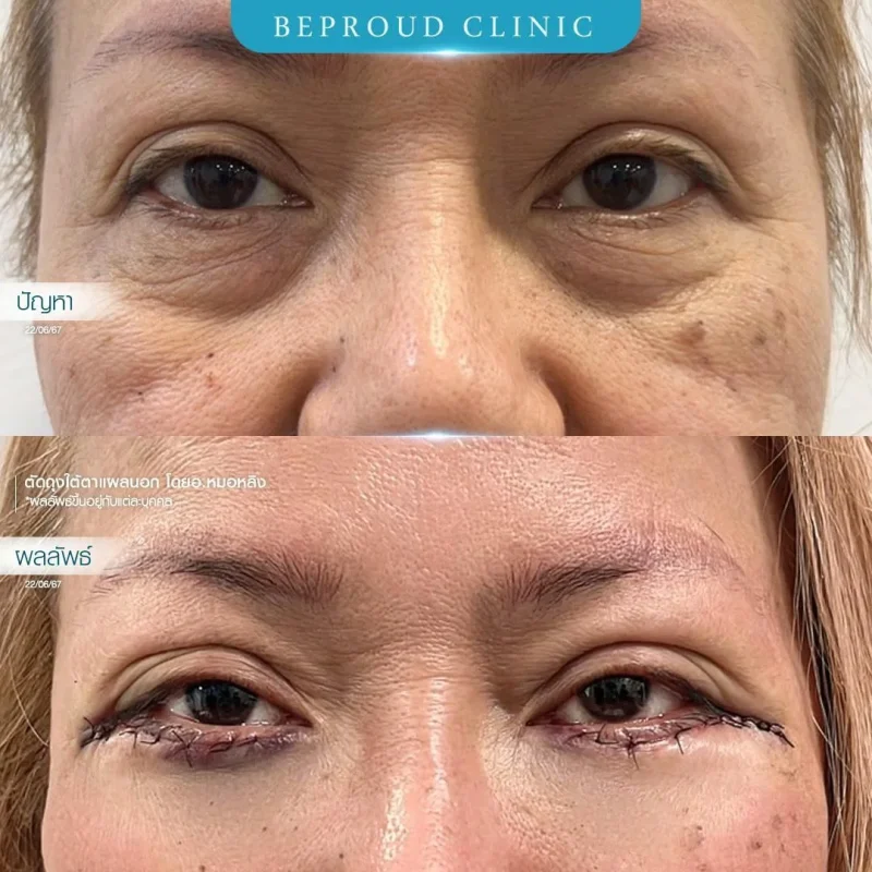 ภาพรีวิวเปรียบเทียบผลลัพธ์ ก่อนทำ-หลังทำศัลยกรรมตัดถุงใต้ตาแผลนอก โดยอ.หมอหลิง บีพราวด์คลินิก
