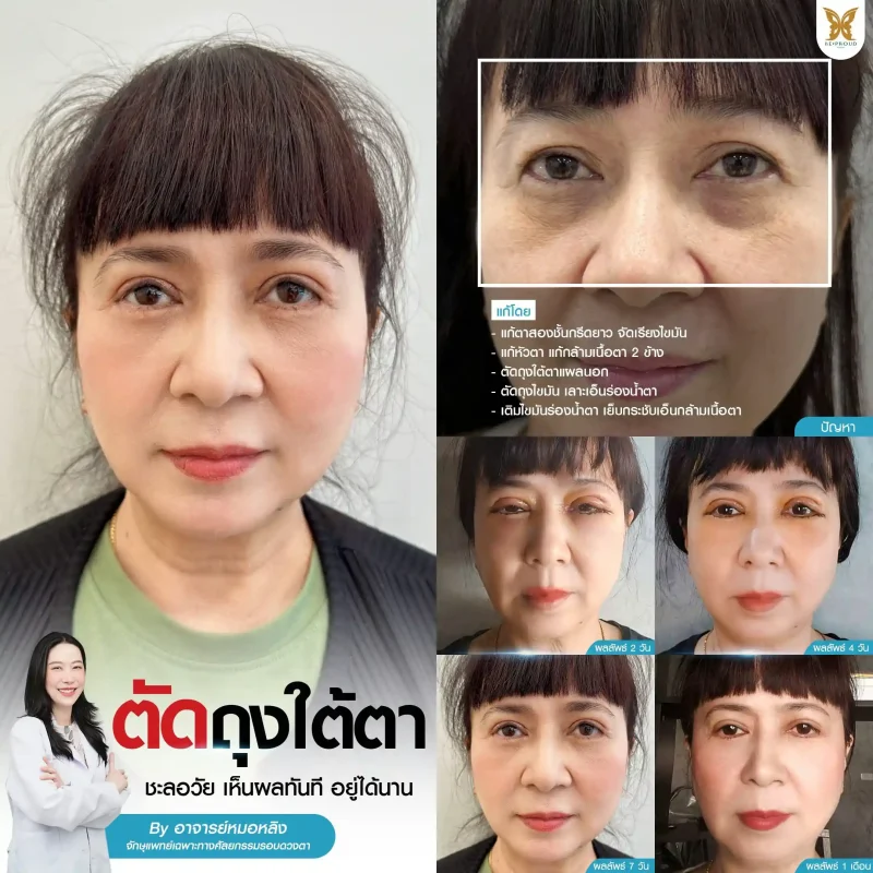 ภาพรีวิวเปรียบเทียบผลลัพธ์ ก่อนทำ-หลังทำศัลยกรรมแก้ตาสองชั้น ของเคสตัวอย่าง เทคนิคกรีดตายาว จัดเรียงไขมัน แก้หัวตา แก้กล้ามเนื้อตาอ่อนแรง ตัดถุงใต้ตาแผลนอก ตัดถุงไขมัน เลาะเอ็นร่องน้ำตา เติมไขมันร่องน้ำตา เย็บกระชับเอ็นกล้ามเนื้อตา โดยอ.หมอหลิง บีพราวด์คลินิก