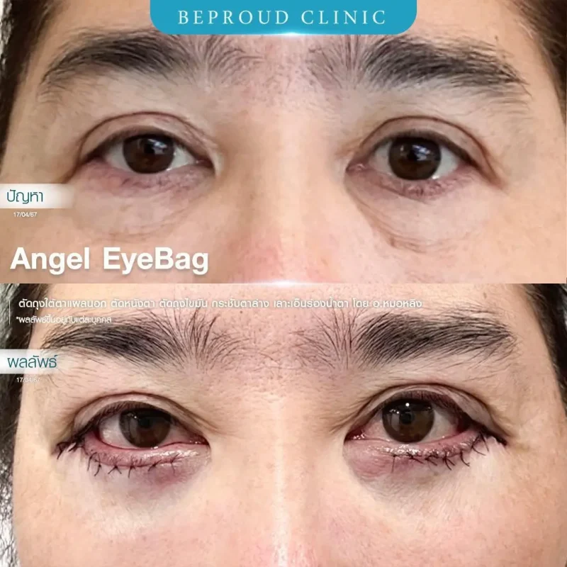 ภาพรีวิวเปรียบเทียบผลลัพธ์ ก่อนทำ-หลังทำศัลยกรรมตัดถุงใต้ตาแผลนอก ตัดหนังตา ตัดถุงไขมัน กระชับเอ็นตาล่าง เลาะเอ็นร่องน้ำตา โดยอ.หมอหลิง บีพราวด์คลินิก