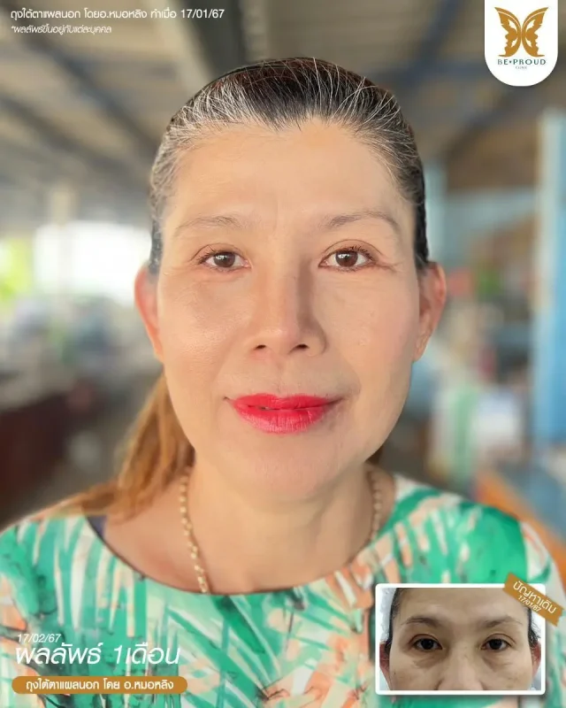 ภาพรีวิวคนสวย ตัดถุงใต้ตาแผลนอก โดย อ.หมอหลิง (พญ.กัญญ์ชิสา) บีพราวด์คลินิก แสดงผลลัพธ์ ชั้นตาสวยคมชัด ดวงตาดูสดใส