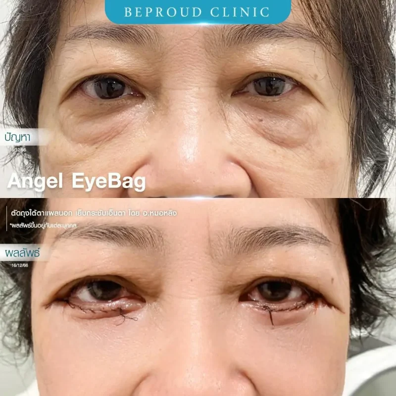 ภาพรีวิวเปรียบเทียบผลลัพธ์ ก่อนทำ-หลังทำศัลยกรรมตัดถุงใต้ตาแผลนอก เย็บกระชับเอ็นตา โดยอ.หมอหลิง บีพราวด์คลินิก