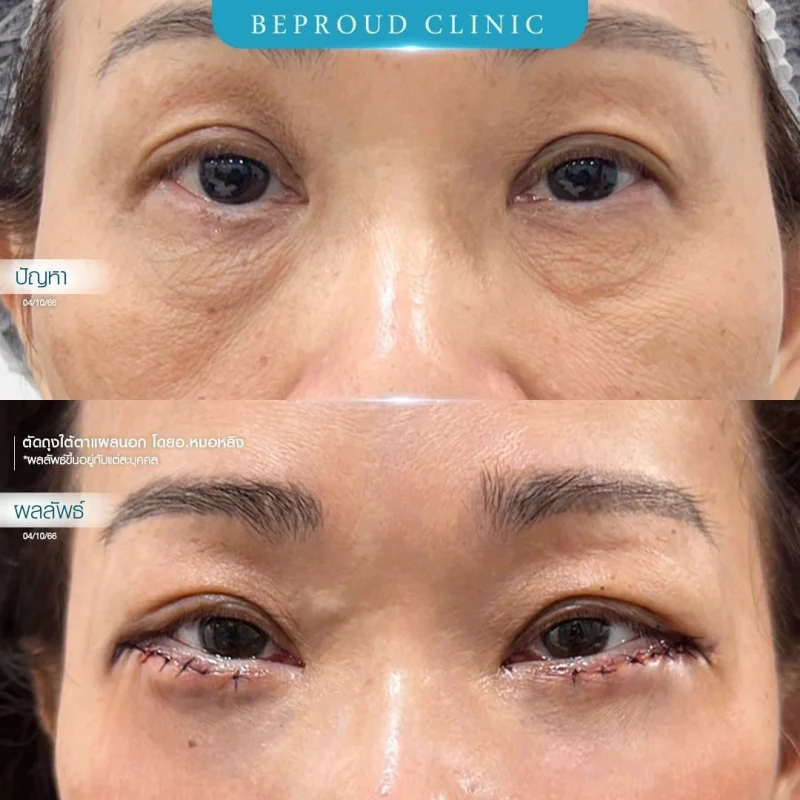 ภาพรีวิวเปรียบเทียบผลลัพธ์ ก่อนทำ-หลังทำศัลยกรรมตัดถุงใต้ตาแผลนอก โดยอ.หมอหลิง บีพราวด์คลินิก