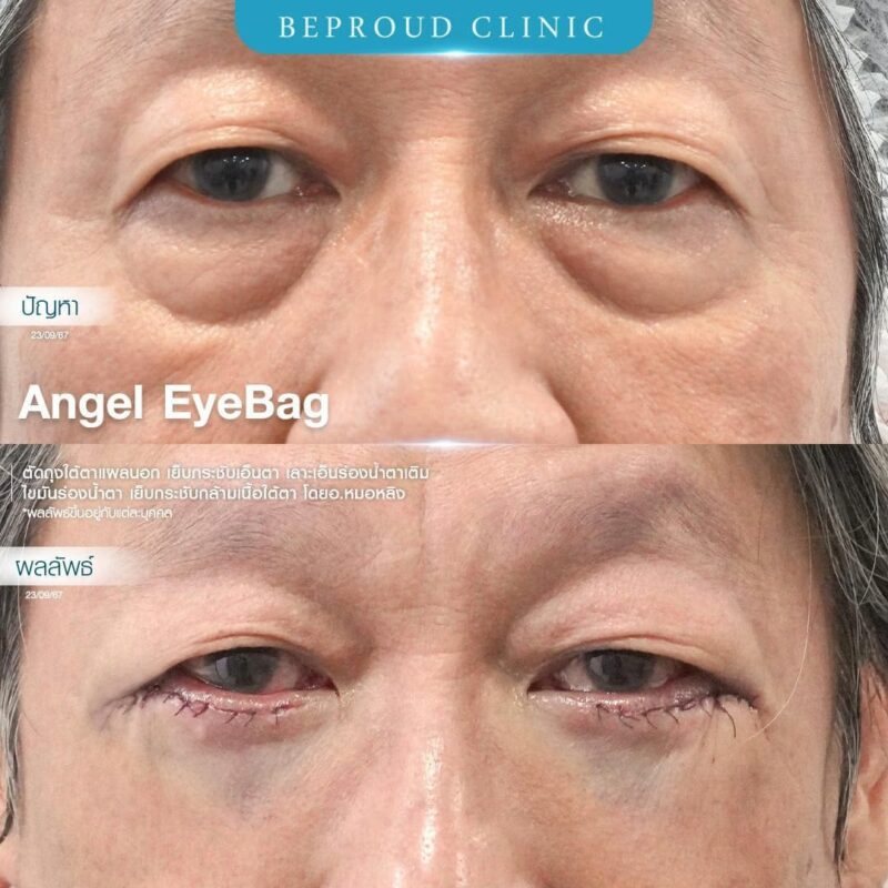 ภาพรีวิวเปรียบเทียบผลลัพธ์ ก่อนทำ-หลังทำศัลยกรรมตัดถุงใต้ตาแผลนอก เย็บกระชับเอ็นตา เลาะเอ็นร่องน้ำตา เติมไขมันร่องน้ำตา เย็บกระชับกล้ามเนื้อใต้ตา โดยอ.หมอหลิง บีพราวด์คลินิก