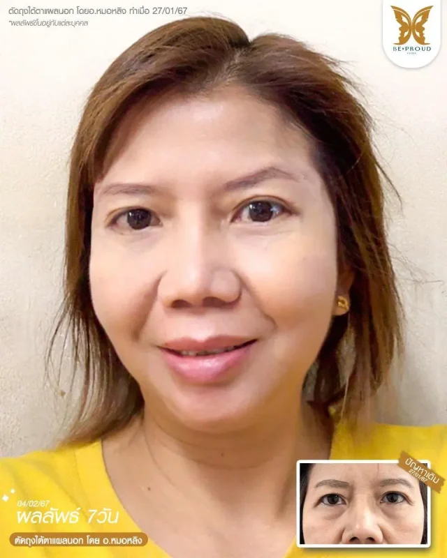 ภาพรีวิวคนสวย ตัดถุงใต้ตาแผลนอก โดย อ.หมอหลิง (พญ.กัญญ์ชิสา) บีพราวด์คลินิก แสดงผลลัพธ์ ชั้นตาสวยคมชัด ดวงตาดูสดใส