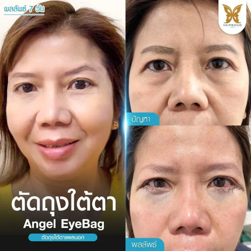 ภาพรีวิวเปรียบเทียบผลลัพธ์ ก่อนทำ-หลังทำศัลยกรรมตัดถุงใต้ตาแผลนอก โดยอ.หมอหลิง บีพราวด์คลินิก