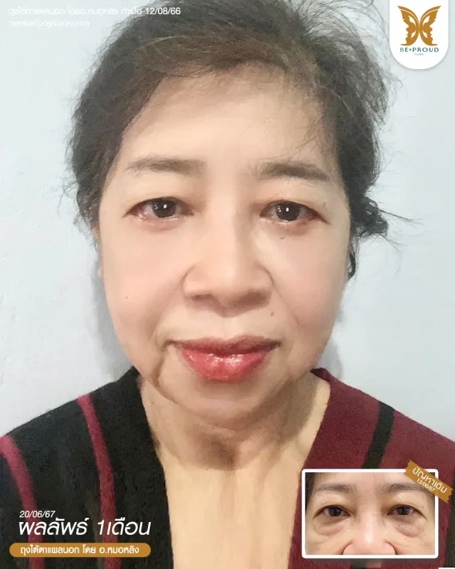 ภาพรีวิวคนสวย ตัดถุงใต้ตาแผลนอก โดย อ.หมอหลิง (พญ.กัญญ์ชิสา) บีพราวด์คลินิก แสดงผลลัพธ์ ชั้นตาสวยคมชัด ดวงตาดูสดใส