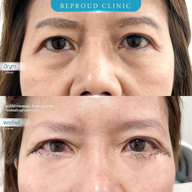 ภาพรีวิวเปรียบเทียบผลลัพธ์ ก่อนทำ-หลังทำศัลยกรรมตัดถุงใต้ตาแผลนอก โดยอ.หมอหลิง บีพราวด์คลินิก