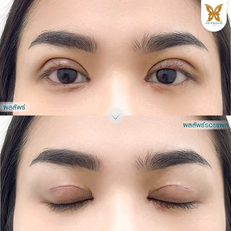 ภาพรีวิวเปรียบเทียบผลลัพธ์ ก่อนทำ-หลังทำศัลยกรรมตาสองชั้น ของเคสตัวอย่าง เทคนิคกรีดตายาว และเปิดหัวตา โดยอ.หมอหลิง บีพราวด์คลินิก