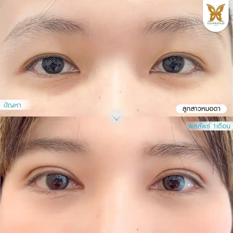 ภาพรีวิวเปรียบเทียบผลลัพธ์ ก่อนทำ-หลังทำศัลยกรรมตาสองชั้น ของเคสตัวอย่าง เทคนิคกรีดตายาว เปิดหัวตา โดยหมอดา บีพราวด์คลินิก