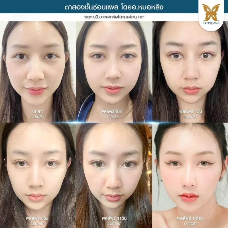 ภาพรีวิวเปรียบเทียบผลลัพธ์ ก่อนทำ-หลังทำศัลยกรรมตาสองชั้น ของเคสตัวอย่าง เทคนิคตาสองชั้นซ่อนแผล โดยอ.หมอหลิง บีพราวด์คลินิก