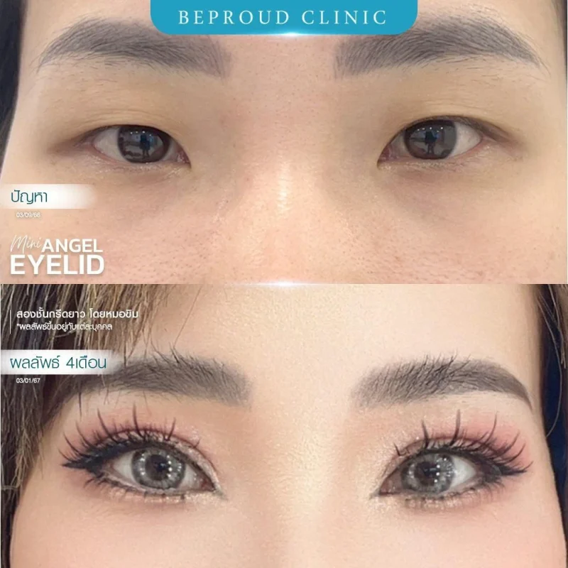 ภาพรีวิวเปรียบเทียบผลลัพธ์ ก่อนทำ-หลังทำศัลยกรรมตาสองชั้น ของเคสตัวอย่าง เทคนิคกรีดตายาว โดยหมอขิม บีพราวด์คลินิก