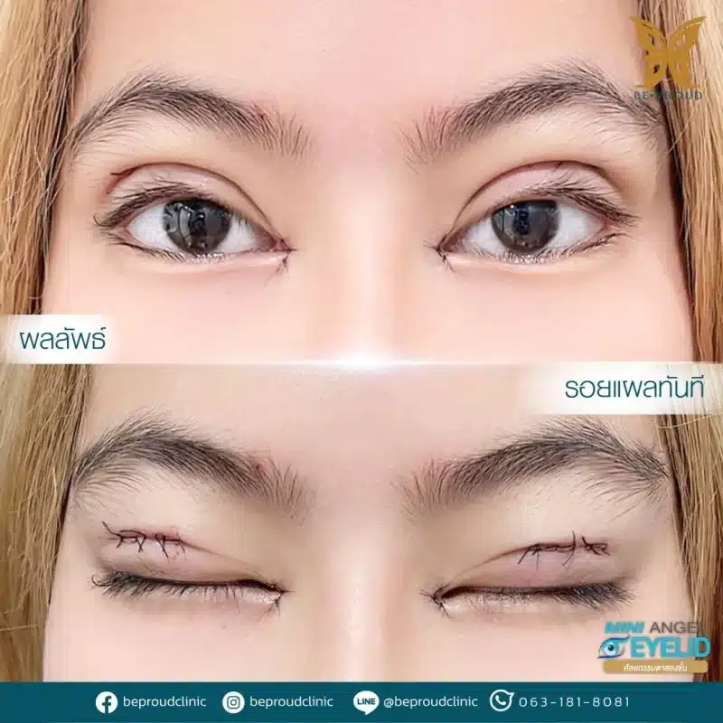 ภาพรีวิวเปรียบเทียบผลลัพธ์ ก่อนทำ-หลังทำศัลยกรรมตาสองชั้น ของเคสตัวอย่าง เทคนิคกรีดตายาวแผลมินิ โดยหมอดา บีพราวด์คลินิก