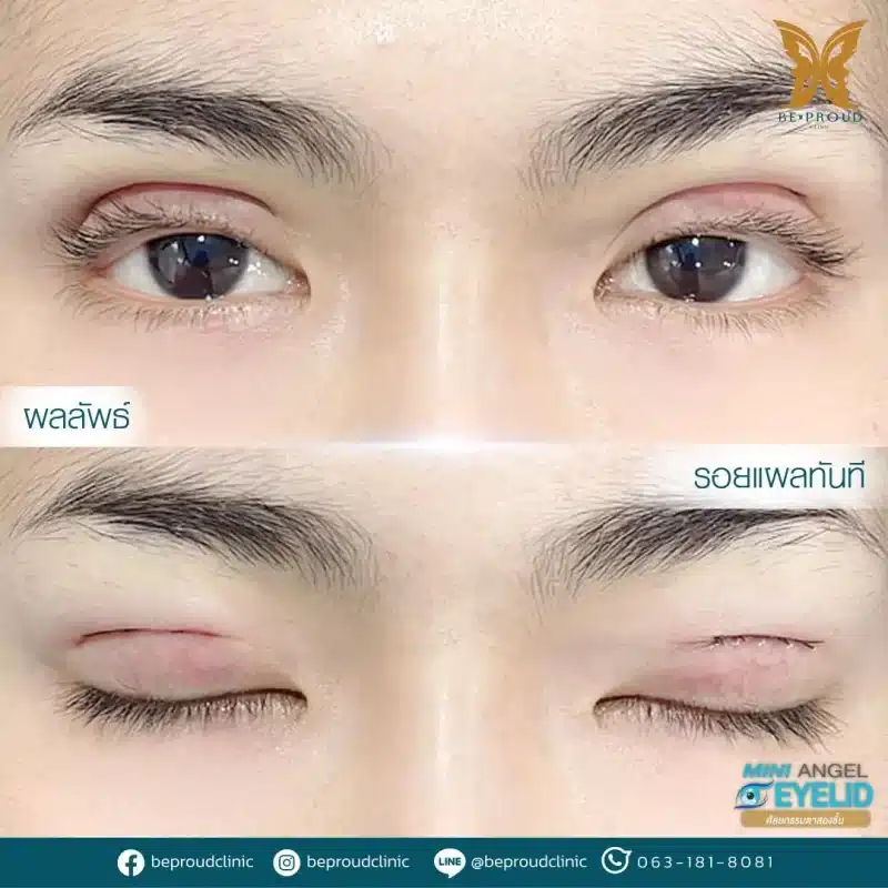 ภาพรีวิวเปรียบเทียบผลลัพธ์ ก่อนทำ-หลังทำศัลยกรรมตาสองชั้น ของเคสตัวอย่าง เทคนิคกรีดตายาวแผลมินิ โดยหมอดา บีพราวด์คลินิก