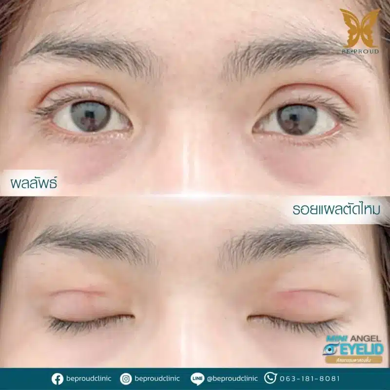 ภาพรีวิวเปรียบเทียบผลลัพธ์ ก่อนทำ-หลังทำศัลยกรรมตาสองชั้น ของเคสตัวอย่าง เทคนิคกรีดตายาวแผลมินิ โดยหมอดา บีพราวด์คลินิก