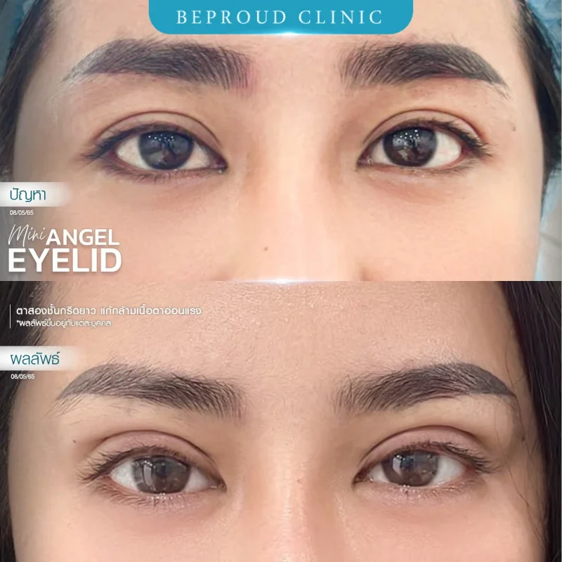 ภาพรีวิวเปรียบเทียบผลลัพธ์ ก่อนทำ-หลังทำศัลยกรรมตาสองชั้น ของเคสตัวอย่าง เทคนิคกรีดตายาว แก้กล้ามเนื้อตาอ่อนแรง โดยหมอต้น บีพราวด์คลินิก