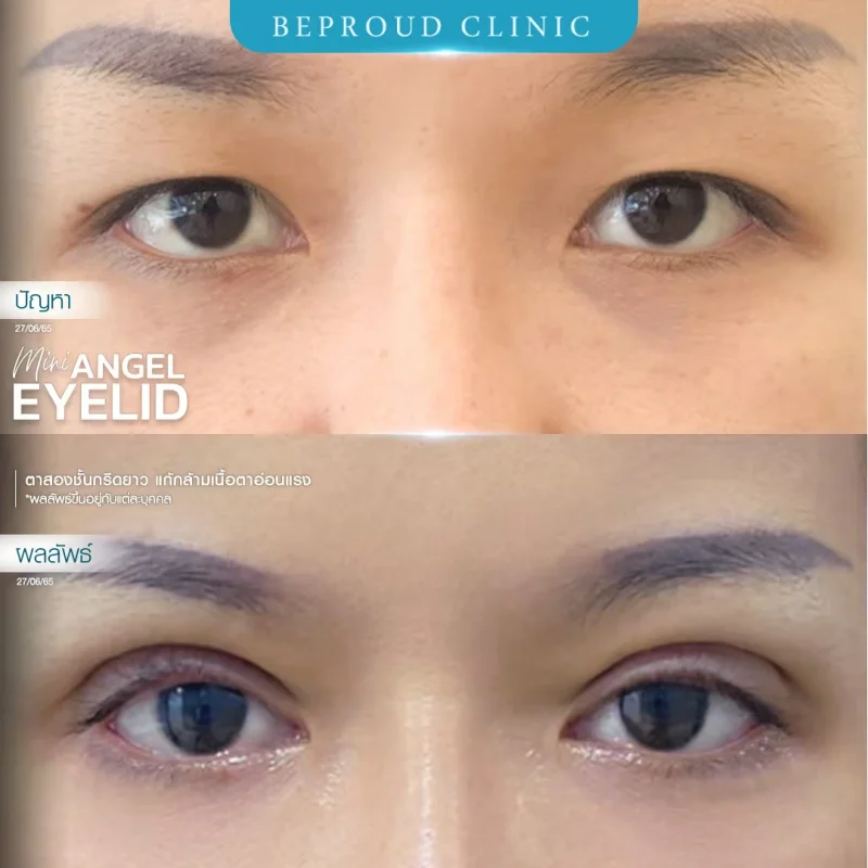 ภาพรีวิวเปรียบเทียบผลลัพธ์ ก่อนทำ-หลังทำศัลยกรรมตาสองชั้น ของเคสตัวอย่าง เทคนิคกรีดตายาว แก้กล้ามเนื้อตาอ่อนแรง โดยหมอต้น บีพราวด์คลินิก