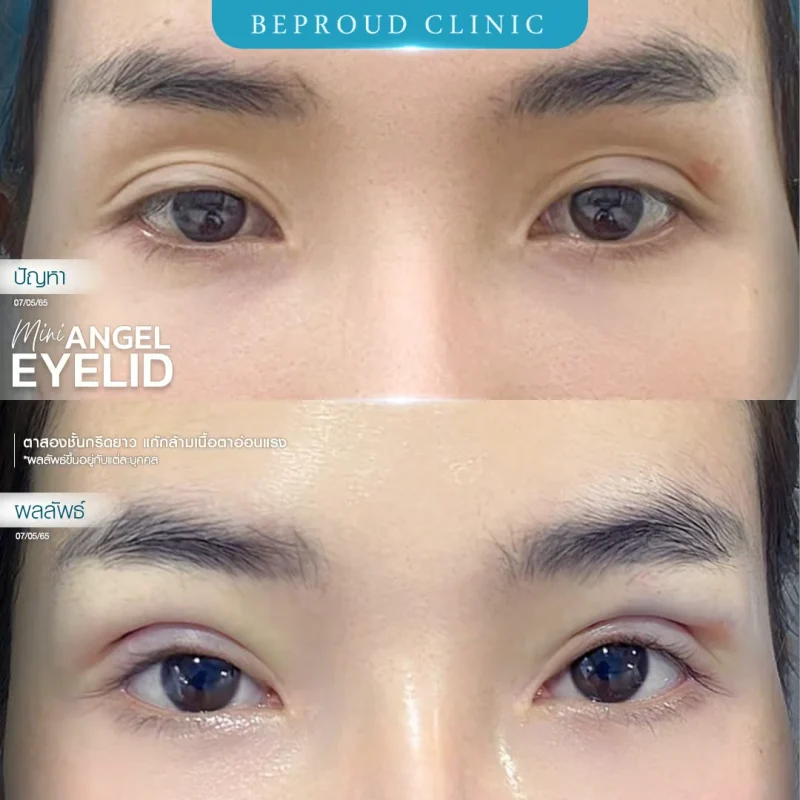 ภาพรีวิวเปรียบเทียบผลลัพธ์ ก่อนทำ-หลังทำศัลยกรรมตาสองชั้น ของเคสตัวอย่าง เทคนิคกรีดตายาว แก้กล้ามเนื้อตาอ่อนแรง โดยหมอต้น บีพราวด์คลินิก