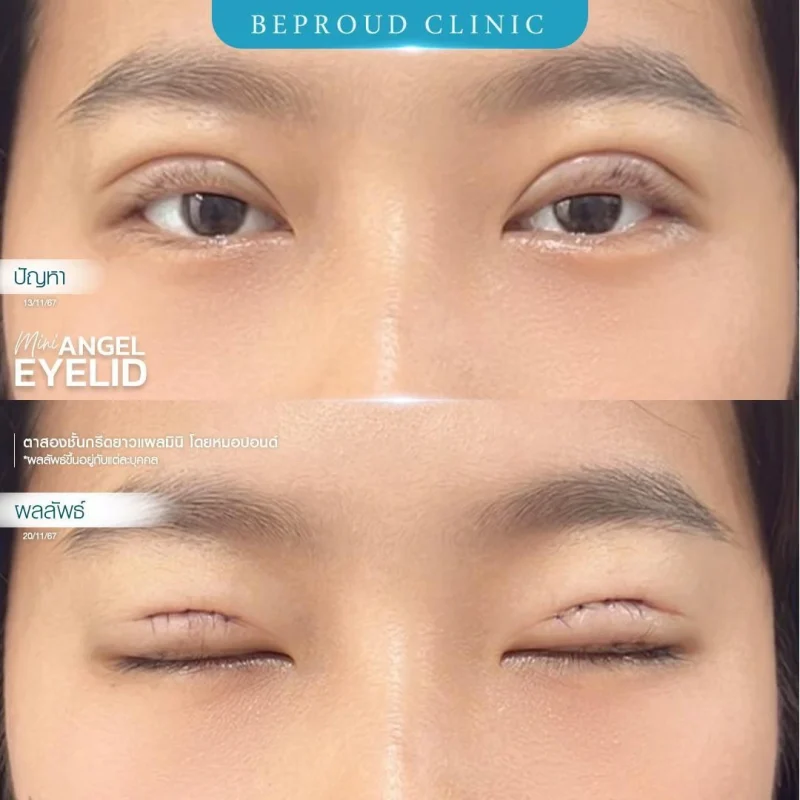 ภาพรีวิวเปรียบเทียบผลลัพธ์ ก่อนทำ-หลังทำศัลยกรรมตาสองชั้น ของเคสตัวอย่าง เทคนิคกรีดตายาวแผลมิน โดยหมอปอนด์ บีพราวด์คลินิก
