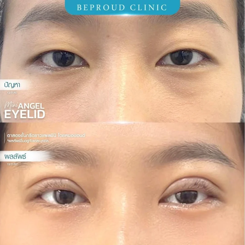 ภาพรีวิวเปรียบเทียบผลลัพธ์ ก่อนทำ-หลังทำศัลยกรรมตาสองชั้น ของเคสตัวอย่าง เทคนิคกรีดตายาวแผลมิน โดยหมอปอนด์ บีพราวด์คลินิก