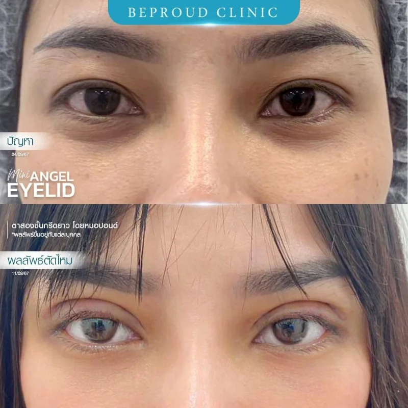 ภาพรีวิวเปรียบเทียบผลลัพธ์ ก่อนทำ-หลังทำศัลยกรรมตาสองชั้น ของเคสตัวอย่าง เทคนิคกรีดตายาว โดยหมอปอนด์ บีพราวด์คลินิก