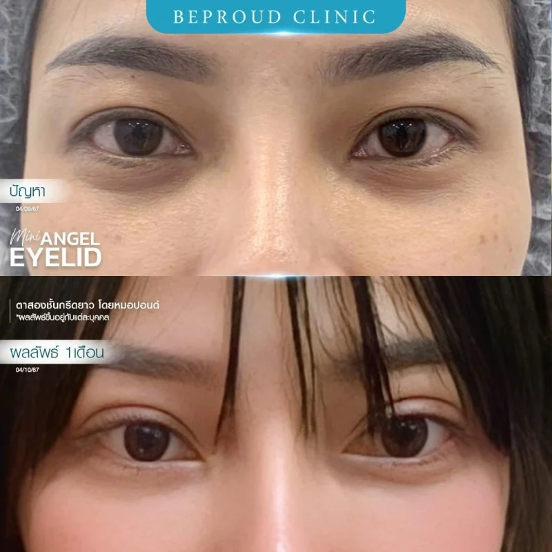 ภาพรีวิวเปรียบเทียบผลลัพธ์ ก่อนทำ-หลังทำศัลยกรรมตาสองชั้น ของเคสตัวอย่าง เทคนิคกรีดตายาว โดยหมอปอนด์ บีพราวด์คลินิก