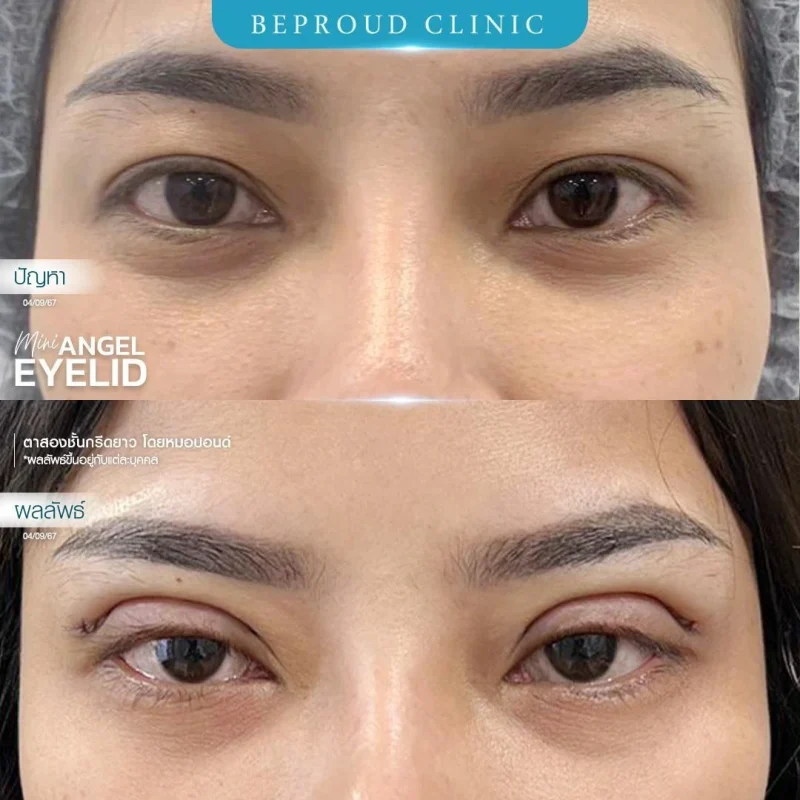 ภาพรีวิวเปรียบเทียบผลลัพธ์ ก่อนทำ-หลังทำศัลยกรรมตาสองชั้น ของเคสตัวอย่าง เทคนิคกรีดตายาว โดยหมอปอนด์ บีพราวด์คลินิก