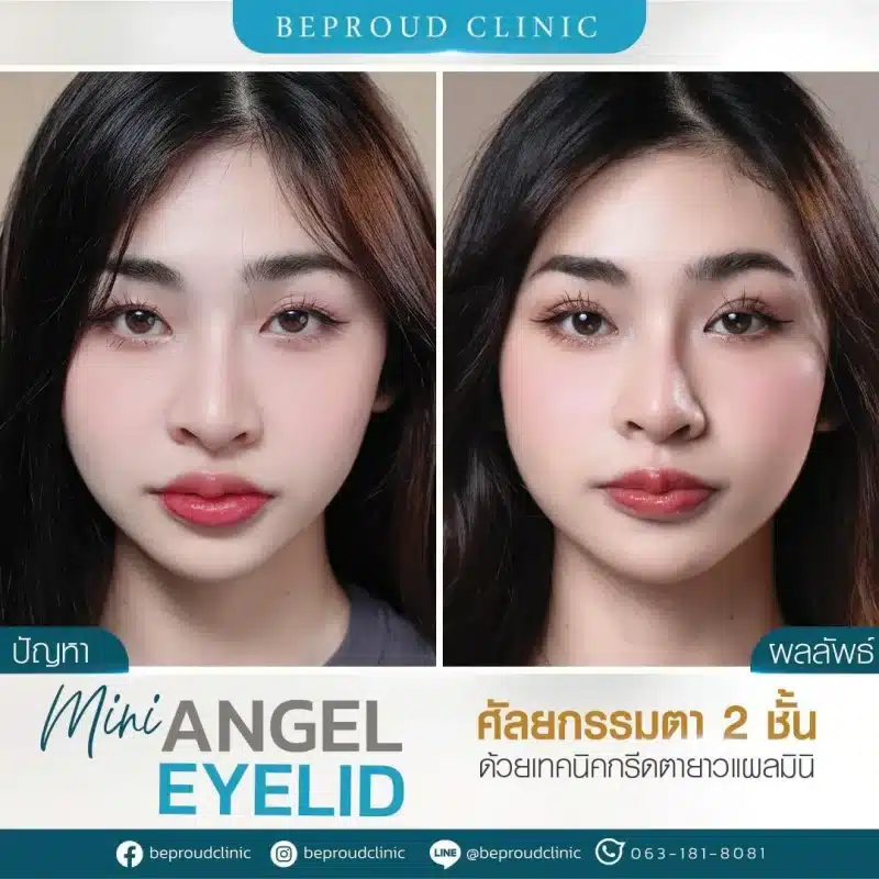 ภาพรีวิวเปรียบเทียบผลลัพธ์ ก่อนทำ-หลังทำศัลยกรรมตาสองชั้น ของเคสตัวอย่าง เทคนิคกรีดตายาวแผลมินิ โดยหมอไบร์ท บีพราวด์คลินิก