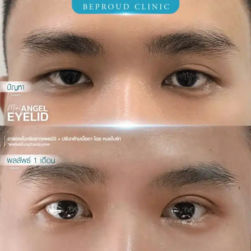 ภาพรีวิวเปรียบเทียบผลลัพธ์ ก่อนทำ-หลังทำศัลยกรรมตาสองชั้นผู้ชาย ของเคสตัวอย่าง เทคนิคกรีดตายาวแผลมินิ โดยหมอไบร์ท บีพราวด์คลินิก