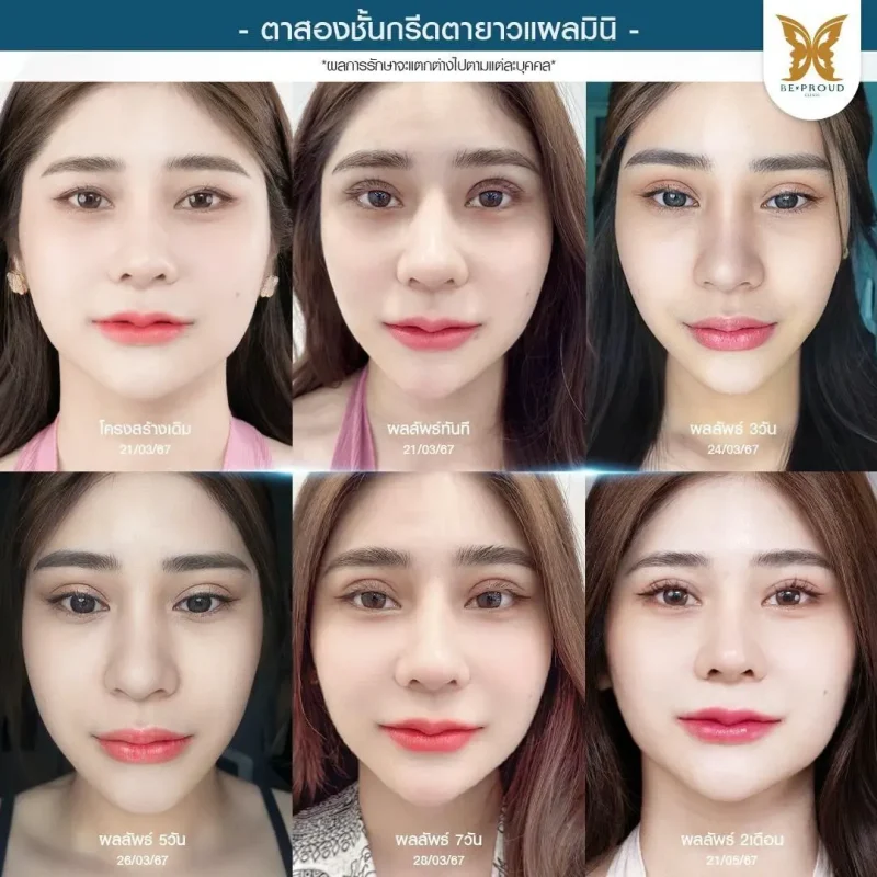 ภาพรีวิวเปรียบเทียบผลลัพธ์ ก่อนทำ-หลังทำศัลยกรรมตาสองชั้น ของเคสตัวอย่าง เทคนิคกรีดตายาวแผลมินิ โดยอ.หมอหลิง บีพราวด์คลินิก