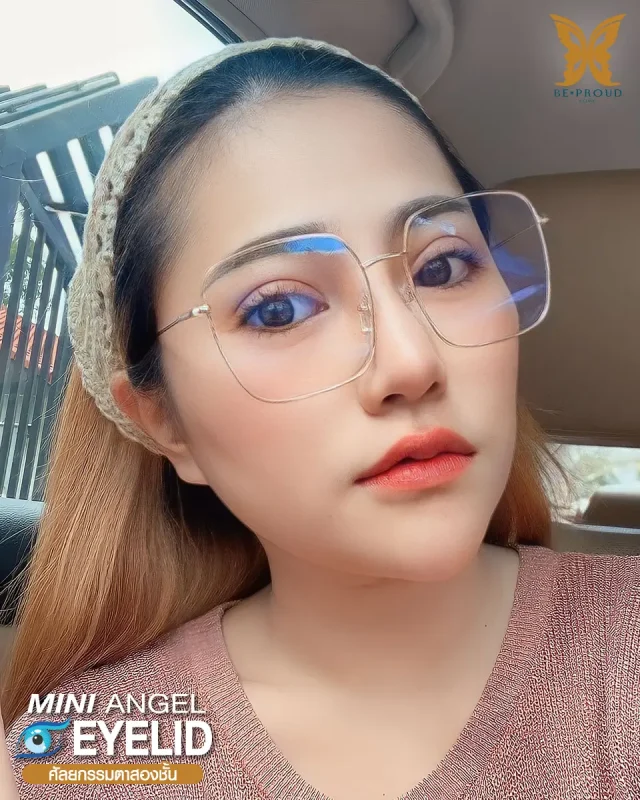 ภาพรีวิวคนสวย ตาสองชั้นกรีดยาว โดยหมอขิม (นพ.นรเศรษฐ์) บีพราวด์คลินิก แสดงผลลัพธ์ ชั้นตาสวยคมชัด ดวงตาดูสดใส