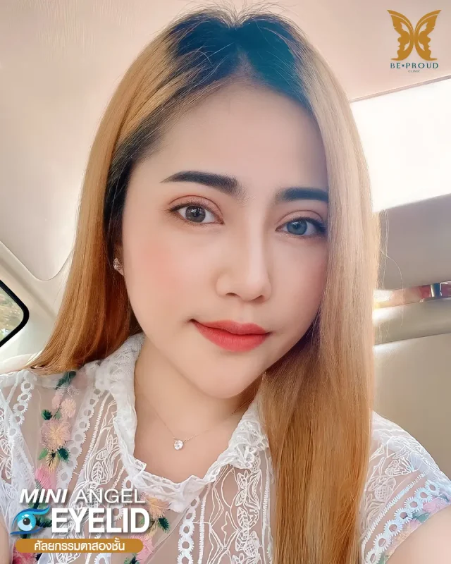 ภาพรีวิวคนสวย ตาสองชั้นกรีดยาว โดยหมอขิม (นพ.นรเศรษฐ์) บีพราวด์คลินิก แสดงผลลัพธ์ ชั้นตาสวยคมชัด ดวงตาดูสดใส