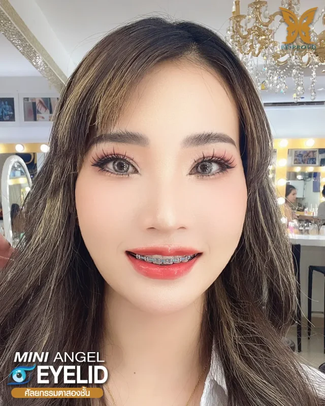 ภาพรีวิวคนสวย ตาสองชั้นกรีดยาว โดยหมอขิม (นพ.นรเศรษฐ์) บีพราวด์คลินิก แสดงผลลัพธ์ ชั้นตาสวยคมชัด ดวงตาดูสดใส