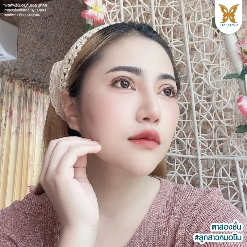 ภาพรีวิวเปรียบเทียบผลลัพธ์ ก่อนทำ-หลังทำศัลยกรรมตาสองชั้น ของเคสตัวอย่าง เทคนิคกรีดตายาว โดยหมอขิม บีพราวด์คลินิก