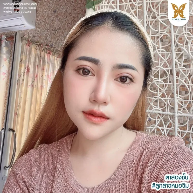 ภาพรีวิวเปรียบเทียบผลลัพธ์ ก่อนทำ-หลังทำศัลยกรรมตาสองชั้น ของเคสตัวอย่าง เทคนิคกรีดตายาว โดยหมอขิม บีพราวด์คลินิก