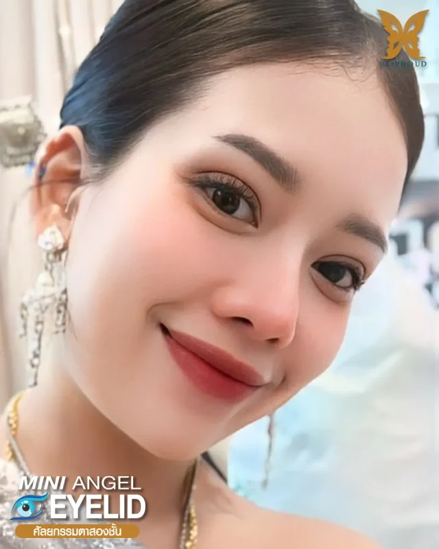 ภาพรีวิวคนสวย ตาสองชั้นกรีดยาว โดยหมอขิม (นพ.นรเศรษฐ์) บีพราวด์คลินิก แสดงผลลัพธ์ ชั้นตาสวยคมชัด ดวงตาดูสดใส