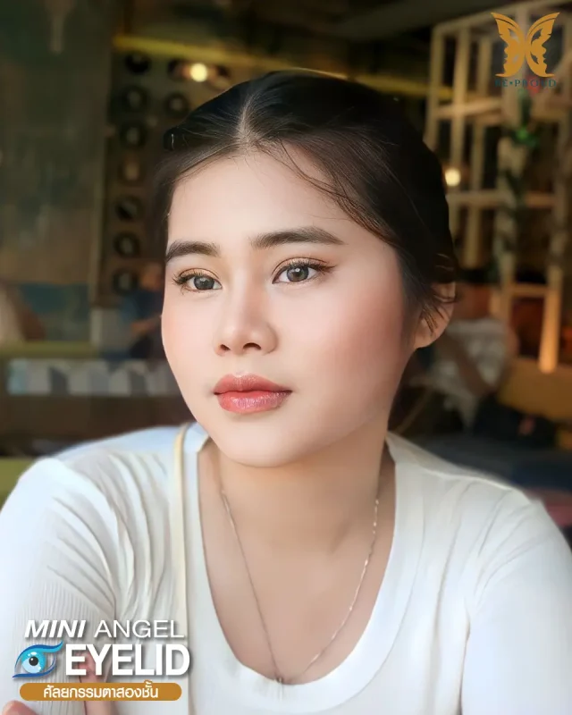 ภาพรีวิวคนสวย ตาสองชั้นกรีดยาว โดยหมอขิม (นพ.นรเศรษฐ์) บีพราวด์คลินิก แสดงผลลัพธ์ ชั้นตาสวยคมชัด ดวงตาดูสดใส