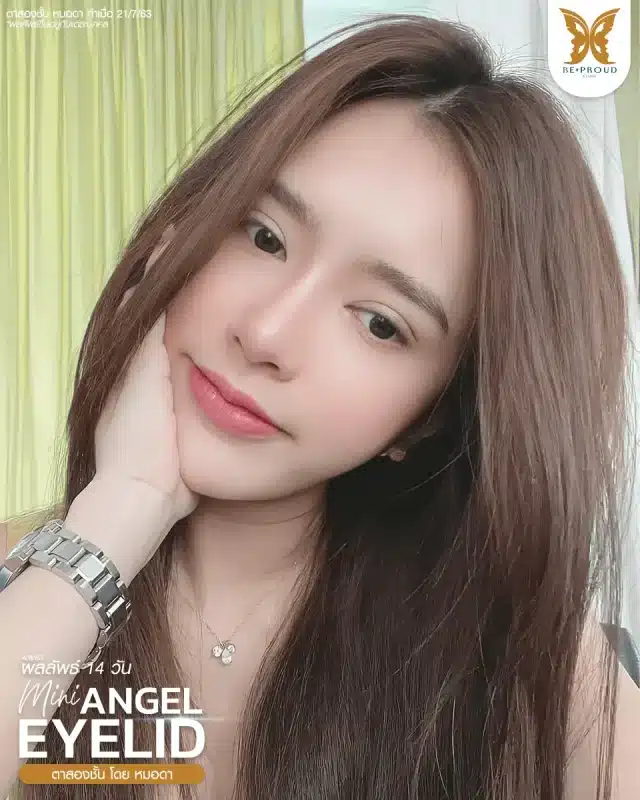 ภาพรีวิวคนสวย ตาสองชั้นกรีดยาวแผลมินิ โดยหมอดา (พญ.สร้อยสุดา) บีพราวด์คลินิก แสดงผลลัพธ์ ชั้นตาสวยคมชัด ดวงตาดูสดใส