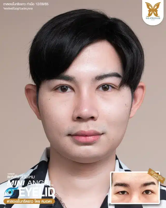 ภาพรีวิวคนสวย ตาสองชั้นผู้ชายกรีดตายาว โดยหมอดา (พญ.สร้อยสุดา) บีพราวด์คลินิก แสดงผลลัพธ์ ชั้นตาสวยคมชัด ดวงตาดูสดใส