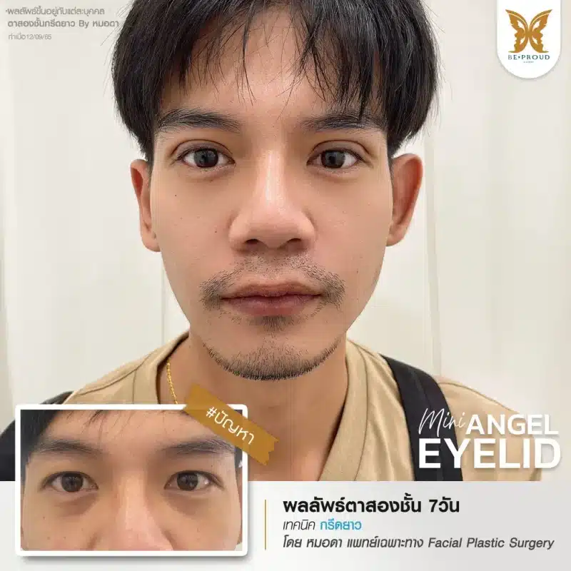 ภาพรีวิวเปรียบเทียบผลลัพธ์ ก่อนทำ-หลังทำศัลยกรรมตาสองชั้นผู้ชาย ของเคสตัวอย่าง เทคนิคกรีดตายาว โดยหมอดา บีพราวด์คลินิก