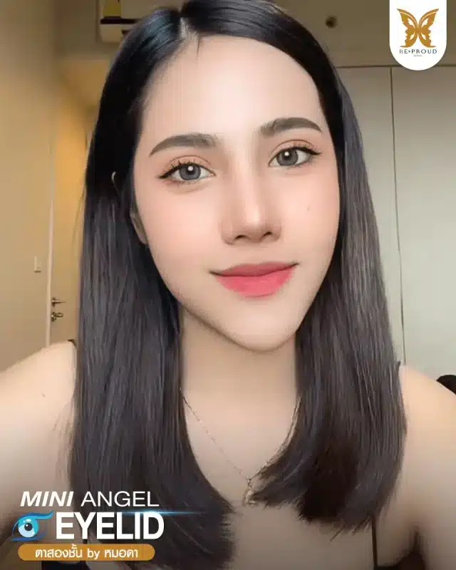 ภาพรีวิวคนสวย ตาสองชั้นกรีดตายาว โดยหมอดา (พญ.สร้อยสุดา) บีพราวด์คลินิก แสดงผลลัพธ์ ชั้นตาสวยคมชัด ดวงตาดูสดใส