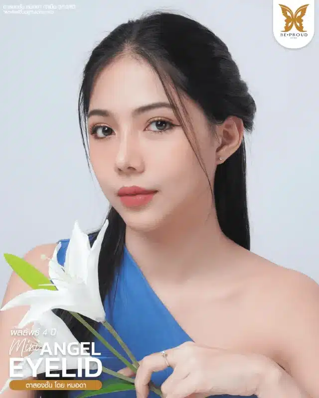 ภาพรีวิวคนสวย ตาสองชั้นกรีดยาวแผลมินิ โดยหมอดา (พญ.สร้อยสุดา) บีพราวด์คลินิก แสดงผลลัพธ์ ชั้นตาสวยคมชัด ดวงตาดูสดใส