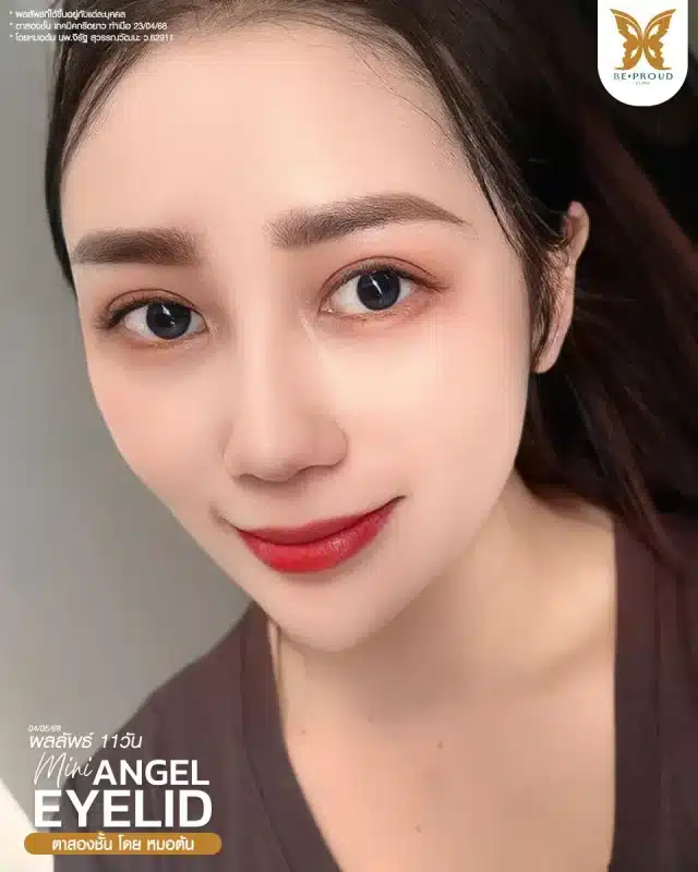 ภาพรีวิวคนสวย ตาสองชั้นกรีดตายาว โดยหมอต้น (นพ.จิรัฐ) บีพราวด์คลินิก แสดงผลลัพธ์ ชั้นตาสวยคมชัด ดวงตาดูสดใส