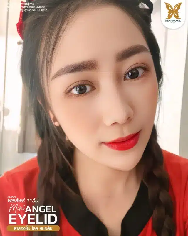 ภาพรีวิวคนสวย ตาสองชั้นกรีดตายาว โดยหมอต้น (นพ.จิรัฐ) บีพราวด์คลินิก แสดงผลลัพธ์ ชั้นตาสวยคมชัด ดวงตาดูสดใส