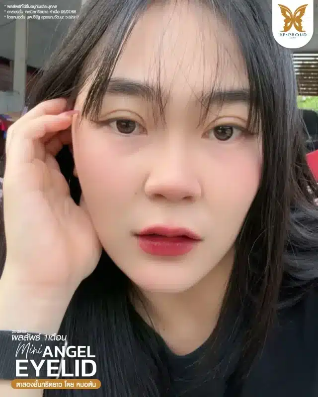 ภาพรีวิวคนสวย ตาสองชั้นกรีดตายาว โดยหมอต้น (นพ.จิรัฐ) บีพราวด์คลินิก แสดงผลลัพธ์ ชั้นตาสวยคมชัด ดวงตาดูสดใส