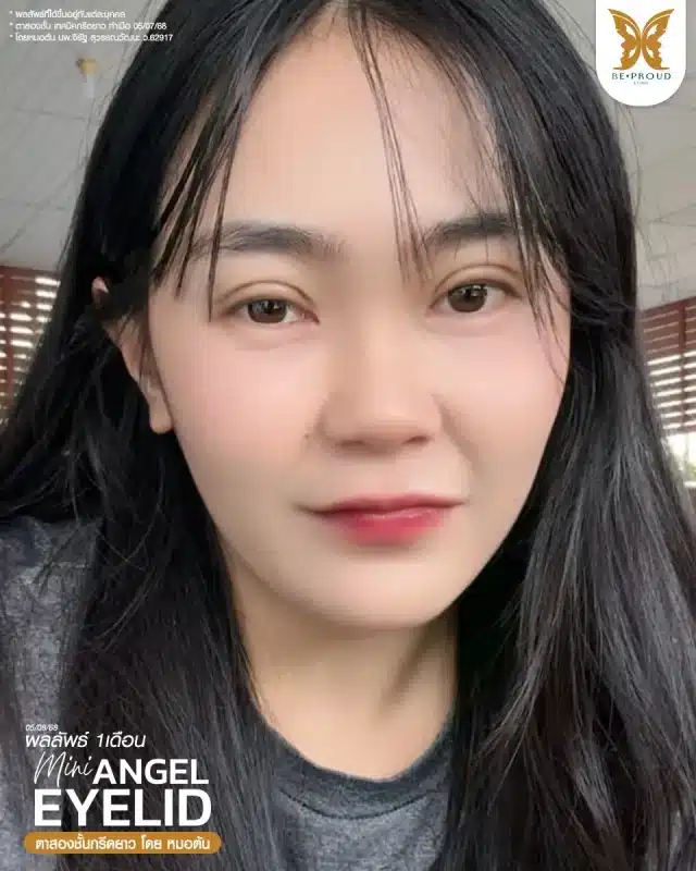 ภาพรีวิวคนสวย ตาสองชั้นกรีดตายาว โดยหมอต้น (นพ.จิรัฐ) บีพราวด์คลินิก แสดงผลลัพธ์ ชั้นตาสวยคมชัด ดวงตาดูสดใส