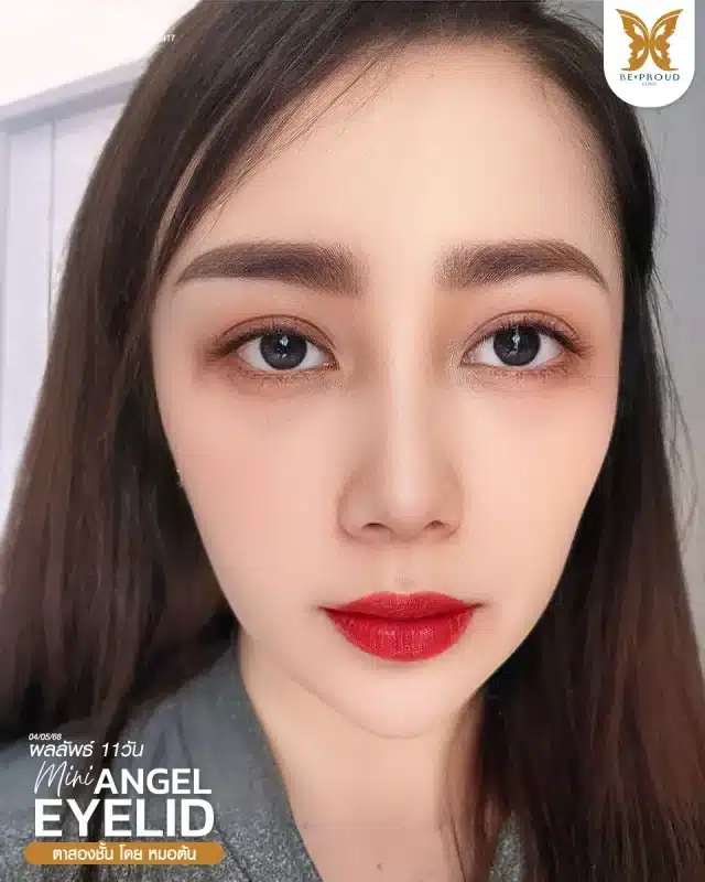 ภาพรีวิวคนสวย ตาสองชั้นกรีดตายาว โดยหมอต้น (นพ.จิรัฐ) บีพราวด์คลินิก แสดงผลลัพธ์ ชั้นตาสวยคมชัด ดวงตาดูสดใส