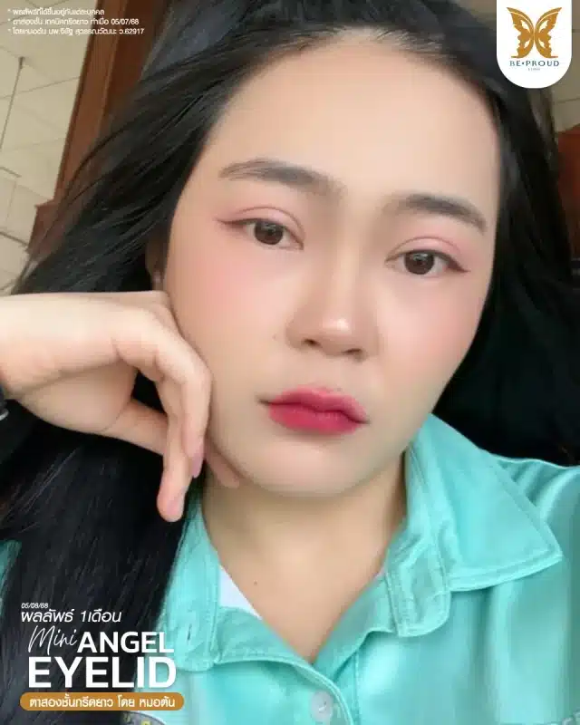 ภาพรีวิวคนสวย ตาสองชั้นกรีดตายาว โดยหมอต้น (นพ.จิรัฐ) บีพราวด์คลินิก แสดงผลลัพธ์ ชั้นตาสวยคมชัด ดวงตาดูสดใส