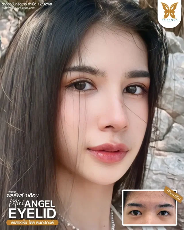 ภาพรีวิวคนสวย ตาสองชั้นกรีดตายาวแผลมินิ โดยหมอปอนด์ (นพ.พิชญ์) บีพราวด์คลินิก แสดงผลลัพธ์ ชั้นตาสวยคมชัด ดวงตาดูสดใส