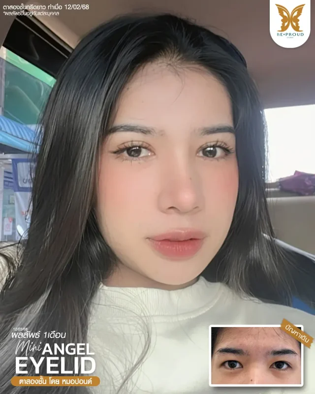 ภาพรีวิวคนสวย ตาสองชั้นกรีดตายาวแผลมินิ โดยหมอปอนด์ (นพ.พิชญ์) บีพราวด์คลินิก แสดงผลลัพธ์ ชั้นตาสวยคมชัด ดวงตาดูสดใส